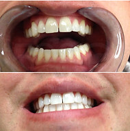 Before and After Teeth Whitening in Denver