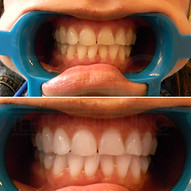 Before and After Teeth Whitening in Denver