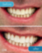 in-office teeth whitening Cherry Creek Denver